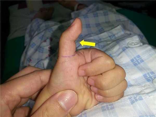 对于小孩而言,具体病因现在还不是很明确,主要表现为拇指伸直受限,可