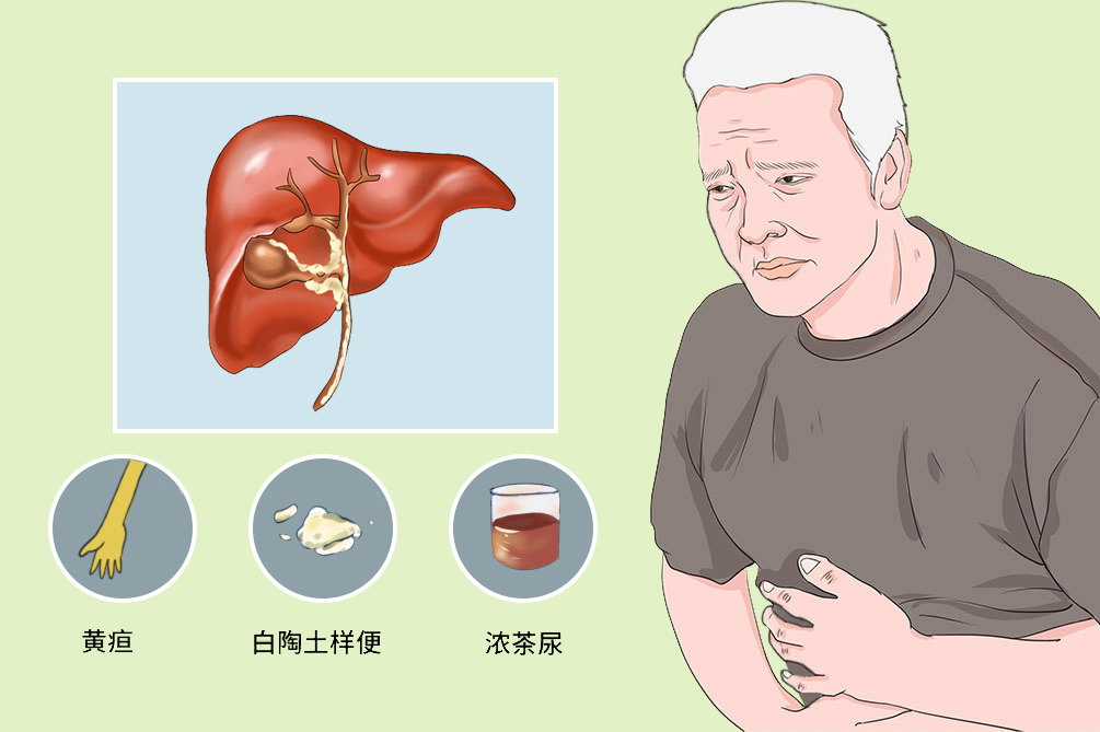 原发性硬化性胆管炎有关,胆管癌患者大多数会出现黄疸,通常为无
